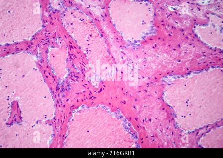 Photomicrographie d'hémangiome caverneux hépatique, représentant des vaisseaux sanguins dilatés dans le tissu hépatique, caractéristique d'une tumeur bénigne. Banque D'Images