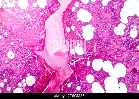 Photomicrographie d'une pneumonie lobaire au cours de la période oedème hémorragique, montrant une inflammation du tissu pulmonaire avec modifications hémorragiques. Banque D'Images