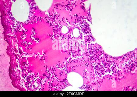 Photomicrographie d'une pneumonie lobaire au cours de la période oedème hémorragique, montrant une inflammation du tissu pulmonaire avec modifications hémorragiques. Banque D'Images