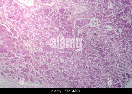 Photomicrographie d'une pneumonie lobaire en phase hépatique grise révélant une transition tissulaire pulmonaire avec alvéoles remplies d'exsudats. Banque D'Images