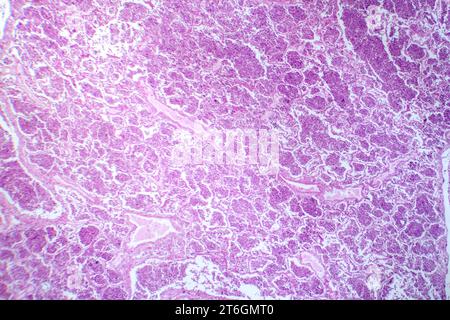 Photomicrographie d'une pneumonie lobaire en phase hépatique grise révélant une transition tissulaire pulmonaire avec alvéoles remplies d'exsudats. Banque D'Images