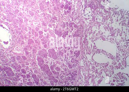 Photomicrographie d'une pneumonie lobaire en phase hépatique grise révélant une transition tissulaire pulmonaire avec alvéoles remplies d'exsudats. Banque D'Images