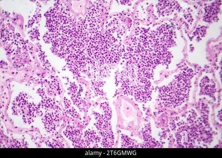 Photomicrographie d'une pneumonie lobaire en phase hépatique grise révélant une transition tissulaire pulmonaire avec alvéoles remplies d'exsudats. Banque D'Images