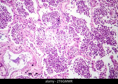 Photomicrographie d'une pneumonie lobaire en phase hépatique grise révélant une transition tissulaire pulmonaire avec alvéoles remplies d'exsudats. Banque D'Images