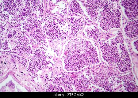 Photomicrographie d'une pneumonie lobaire en phase hépatique grise révélant une transition tissulaire pulmonaire avec alvéoles remplies d'exsudats. Banque D'Images