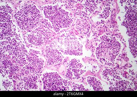 Photomicrographie d'une pneumonie lobaire en phase hépatique grise révélant une transition tissulaire pulmonaire avec alvéoles remplies d'exsudats. Banque D'Images