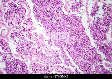 Photomicrographie d'une pneumonie lobaire en phase hépatique grise révélant une transition tissulaire pulmonaire avec alvéoles remplies d'exsudats. Banque D'Images