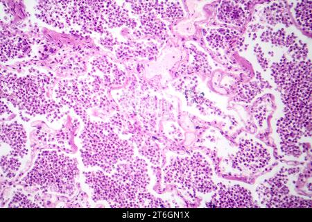 Photomicrographie d'une pneumonie lobaire en phase hépatique grise révélant une transition tissulaire pulmonaire avec alvéoles remplies d'exsudats. Banque D'Images