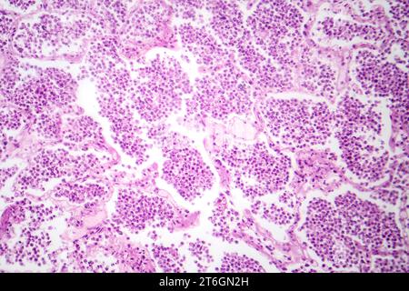 Photomicrographie d'une pneumonie lobaire en phase hépatique grise révélant une transition tissulaire pulmonaire avec alvéoles remplies d'exsudats. Banque D'Images