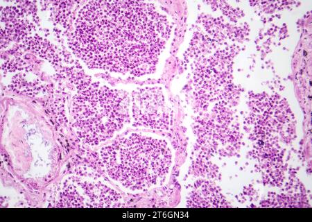 Photomicrographie d'une pneumonie lobaire en phase hépatique grise révélant une transition tissulaire pulmonaire avec alvéoles remplies d'exsudats. Banque D'Images