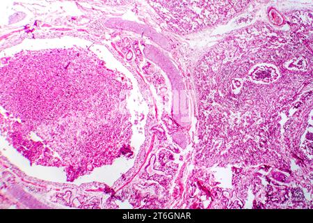 Photomicrographie de bronchopneumonie, illustrant l'inflammation et la consolidation du tissu pulmonaire par infection bactérienne. Banque D'Images