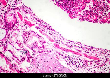 Photomicrographie de bronchopneumonie, illustrant l'inflammation et la consolidation du tissu pulmonaire par infection bactérienne. Banque D'Images