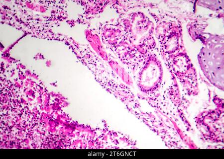 Photomicrographie de bronchopneumonie, illustrant l'inflammation et la consolidation du tissu pulmonaire par infection bactérienne. Banque D'Images