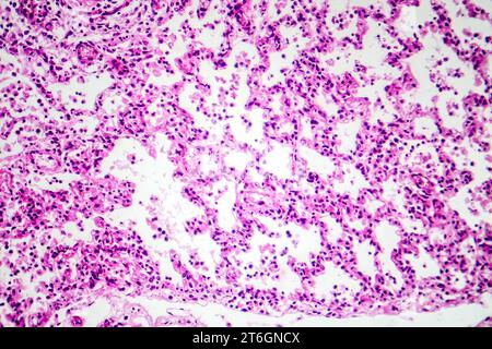 Photomicrographie de bronchopneumonie, illustrant l'inflammation et la consolidation du tissu pulmonaire par infection bactérienne. Banque D'Images