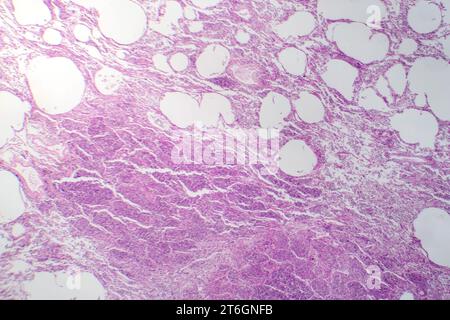 Photomicrographie d'une pneumonie interstitielle montrant inflammation et fibrose du tissu interstitiel pulmonaire. Banque D'Images