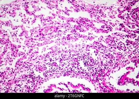 Photomicrographie de bronchopneumonie, illustrant l'inflammation et la consolidation du tissu pulmonaire par infection bactérienne. Banque D'Images