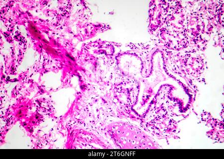 Photomicrographie de bronchopneumonie, illustrant l'inflammation et la consolidation du tissu pulmonaire par infection bactérienne. Banque D'Images