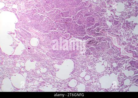 Photomicrographie d'une pneumonie interstitielle montrant inflammation et fibrose du tissu interstitiel pulmonaire. Banque D'Images