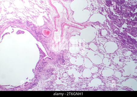 Photomicrographie d'une pneumonie interstitielle montrant inflammation et fibrose du tissu interstitiel pulmonaire. Banque D'Images