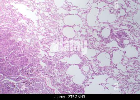 Photomicrographie d'une pneumonie interstitielle montrant inflammation et fibrose du tissu interstitiel pulmonaire. Banque D'Images