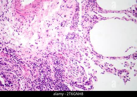 Photomicrographie d'une pneumonie interstitielle montrant inflammation et fibrose du tissu interstitiel pulmonaire. Banque D'Images