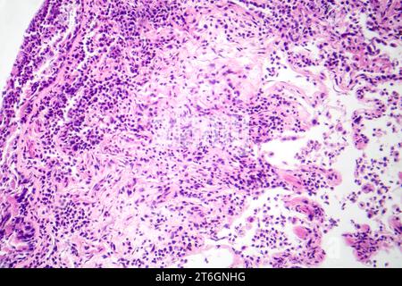 Photomicrographie d'une pneumonie interstitielle montrant inflammation et fibrose du tissu interstitiel pulmonaire. Banque D'Images