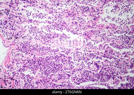 Photomicrographie d'une pneumonie interstitielle montrant inflammation et fibrose du tissu interstitiel pulmonaire. Banque D'Images