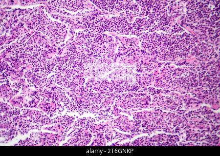 Photomicrographie d'une pneumonie interstitielle montrant inflammation et fibrose du tissu interstitiel pulmonaire. Banque D'Images