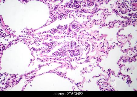 Photomicrographie d'une pneumonie interstitielle montrant inflammation et fibrose du tissu interstitiel pulmonaire. Banque D'Images