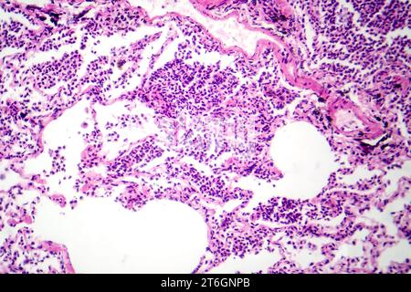 Photomicrographie d'une pneumonie interstitielle montrant inflammation et fibrose du tissu interstitiel pulmonaire. Banque D'Images