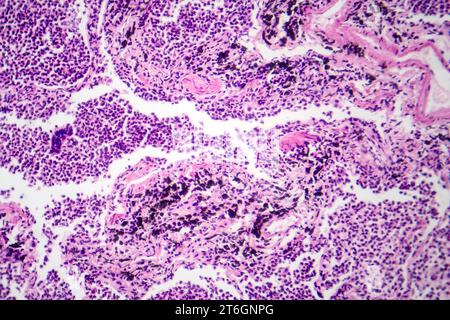 Photomicrographie d'une pneumonie interstitielle montrant inflammation et fibrose du tissu interstitiel pulmonaire. Banque D'Images