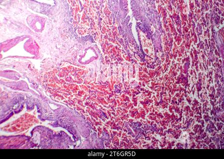 Photomicrographie d'une hémorragie pulmonaire aiguë, montrant des alvéoles remplies de sang et des lésions des tissus pulmonaires dues à un saignement. Banque D'Images