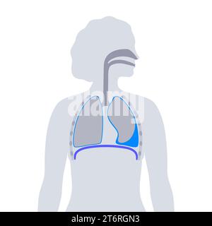 Épanchement pleural, illustration Banque D'Images