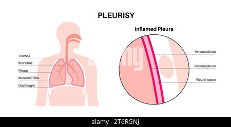Pleurésie, illustration. Banque D'Images