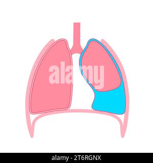 Épanchement pleural, illustration Banque D'Images