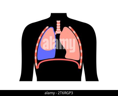 Épanchement pleural, illustration Banque D'Images