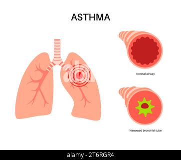 Asthme, illustration Banque D'Images