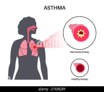 Asthme, illustration. Banque D'Images