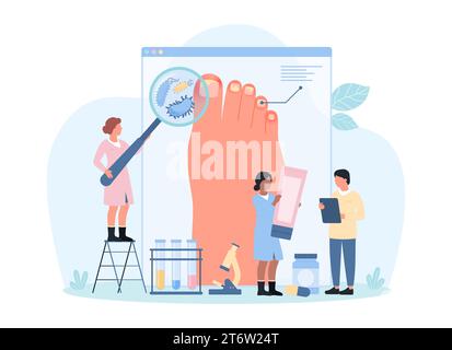 Diagnostic et traitement de l'infection fongique et de la maladie des ongles, illustration vectorielle de l'onychomycose. Dessins animés médecins minuscules avec loupe diagnostiquer m Illustration de Vecteur