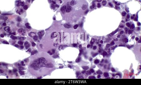 Moelle osseuse rouge, micrographie légère. Il se compose principalement de tissu hématopoïétique, où les cellules sanguines sont créées. Au centre se trouvent trois mégacaryocytes. Banque D'Images