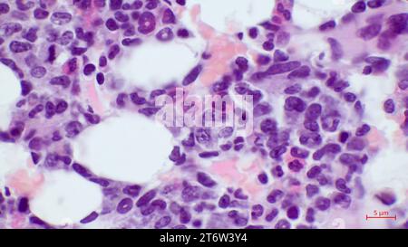 Section histologique de moelle osseuse rouge avec îlots hématopoïétiques. Image de microscopie optique montrant la formation de cellules sanguines dans le tissu de moelle humaine. Banque D'Images
