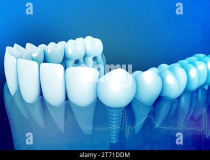 Anatomie dentaire avec implant dentaire. rendu 3d. Banque D'Images