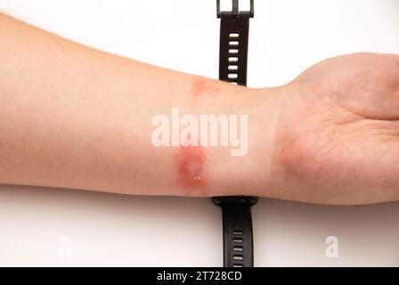 Irritation, rougeur et démangeaisons sur la peau après avoir porté une montre ou un bracelet fitness. Allergie au bracelet de montre, dermatite de contact. Banque D'Images