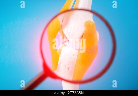 Maquette médicale d'une articulation du genou sur fond bleu sous une loupe. Concept de douleur et d'inflammation dans l'articulation du genou, rougeur. Gonarthrosi Banque D'Images