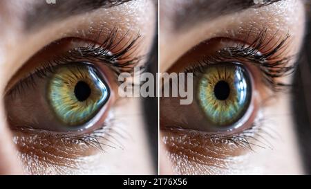 Macro avant et après chirurgie d'un oeil féminin clair d'une femme caucasienne atteinte de kératocône. Une déformation conique de la cornée Banque D'Images