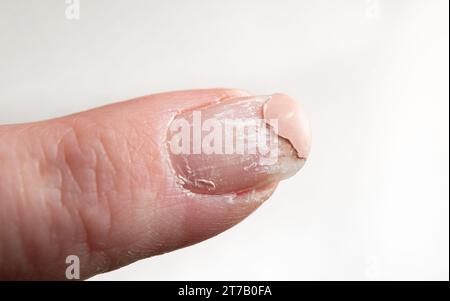 Vue rapprochée des couches décollant l'ongle endommagé après l'utilisation de vernis à ongles UV. Maison à l'intérieur. Banque D'Images