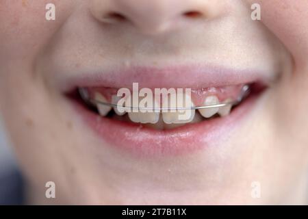 Large sourire d'adolescent, dents avec des bagues rapprochées. Jeune étudiant souriant portrait de bouche montrant des dents avec des bagues rapprochées. Le concept d'odontologie et d'orthodontie. Banque D'Images