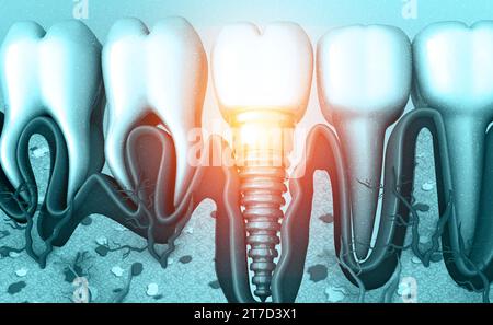 Implant dentaire, concept dentaire. illustration 3d. Banque D'Images