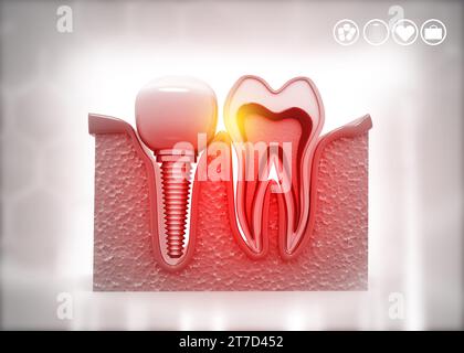 Implant dentaire, concept dentaire. illustration 3d. Banque D'Images