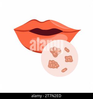 Illustration isolée de vecteur de l'herpès sur les lèvres. Infection par le virus de l'herpès. Immunité diminuée. Illustration de Vecteur